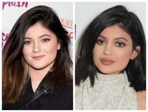 kylie-jenner-lip-fillers-300x227