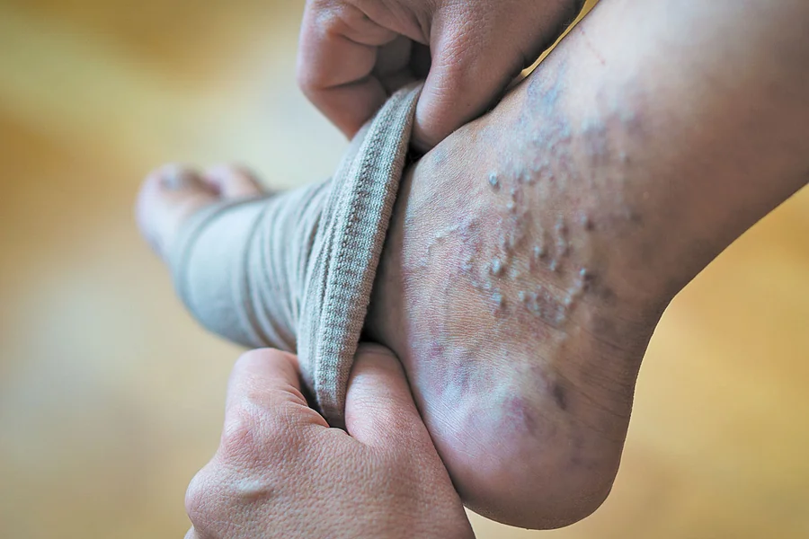 Varicose Vein