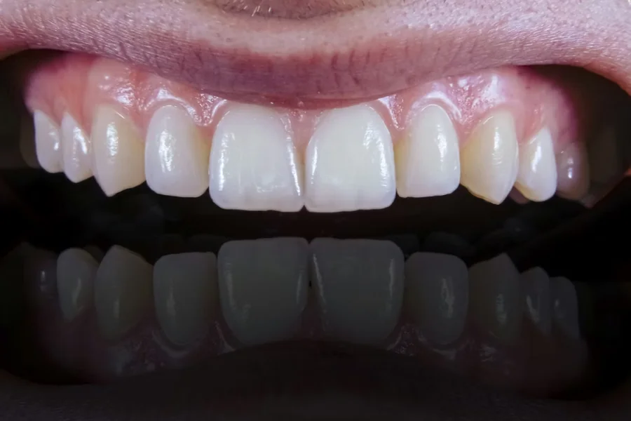 Dental Restoration