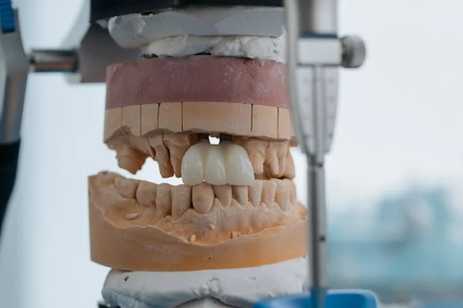Dental Bridges